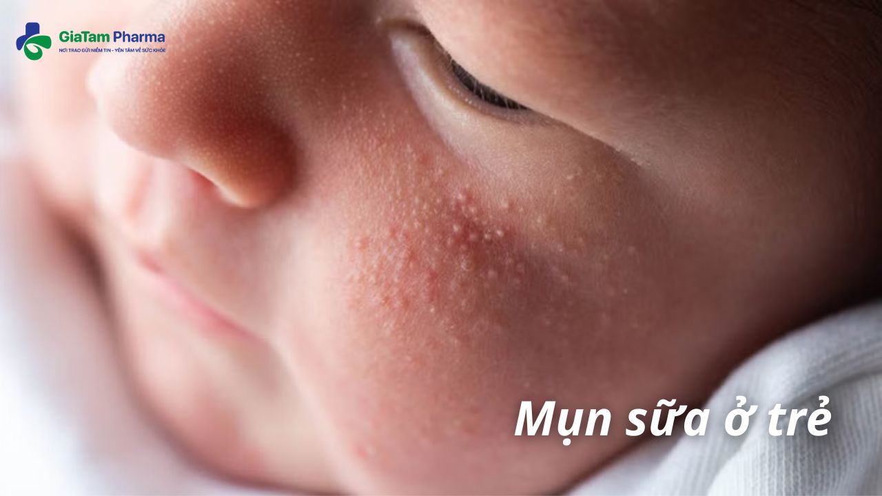 mụn sữa ở trẻ sơ sinh