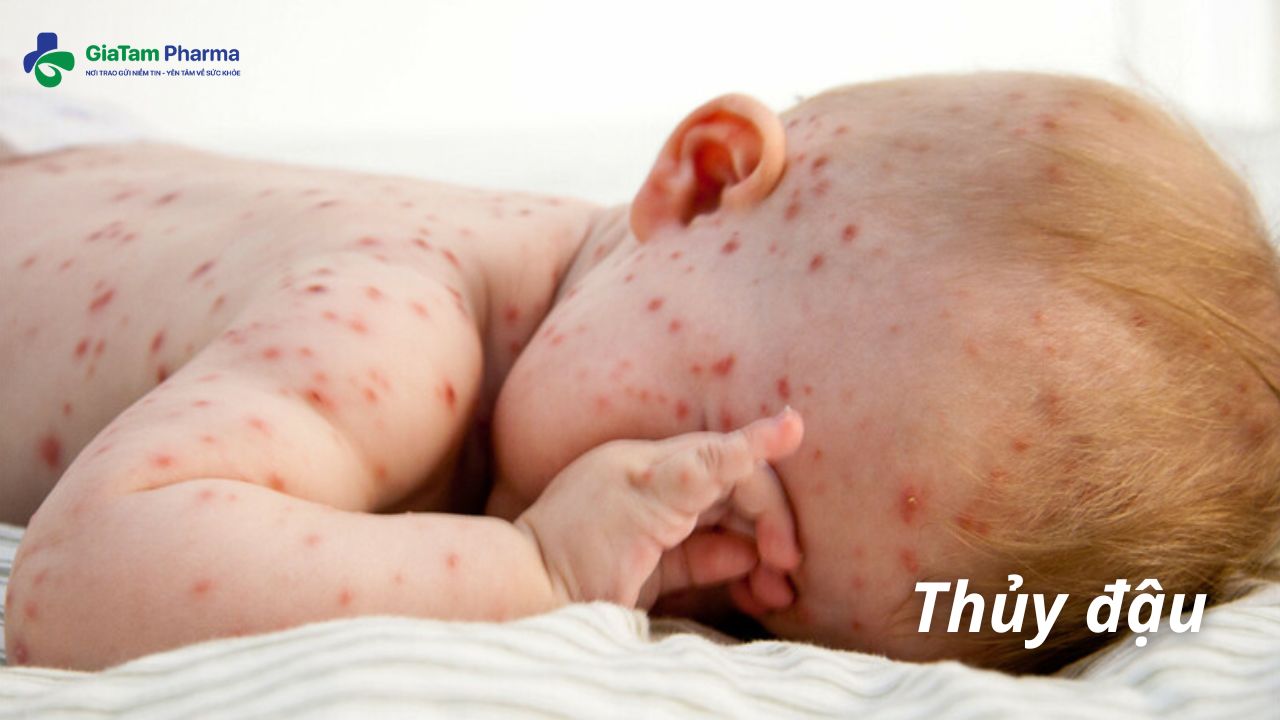Thủy đậu - các bệnh về da ở trẻ sơ sinh