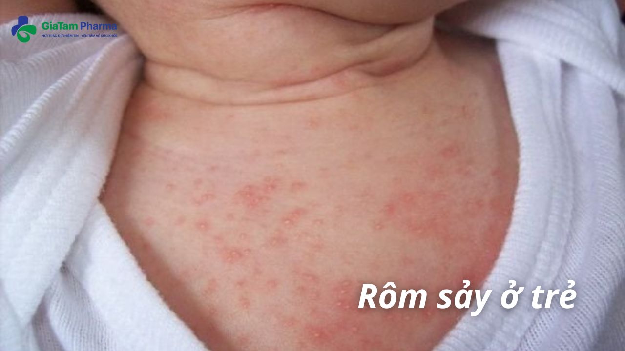 các bệnh về da hay gặp ở trẻ sơ sinh