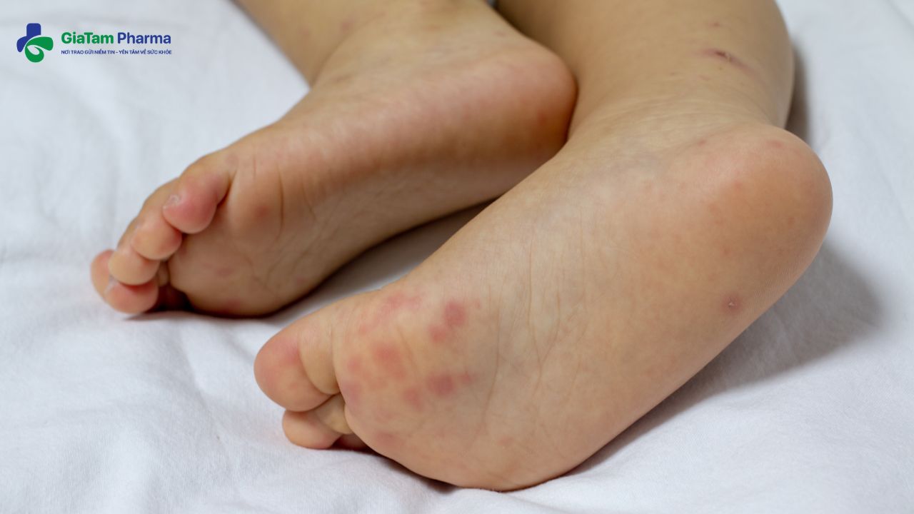 Các bệnh về da thường gặp ở trẻ sơ sinh